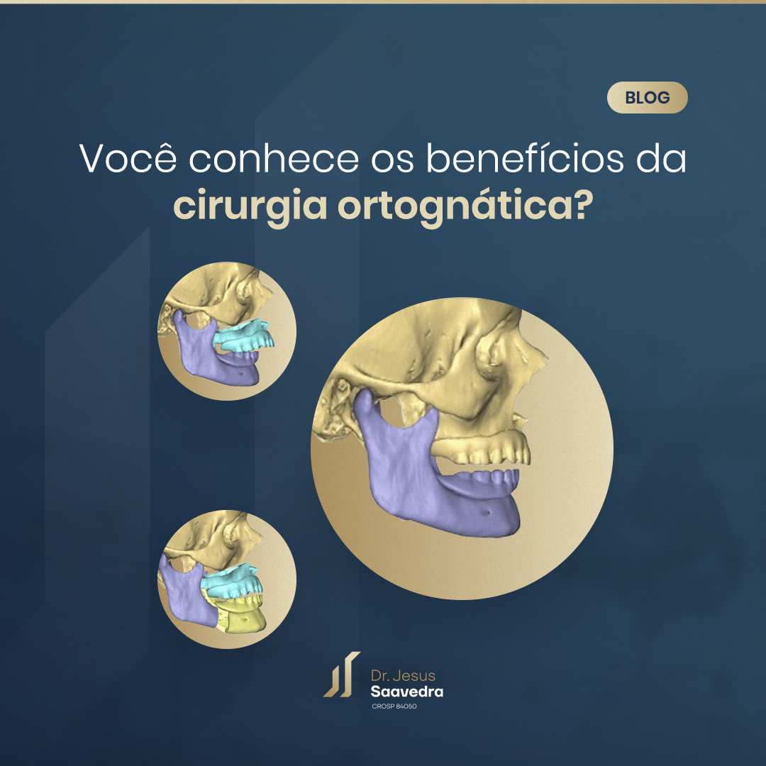 Você conhece os benefícios da cirurgia ortognática?