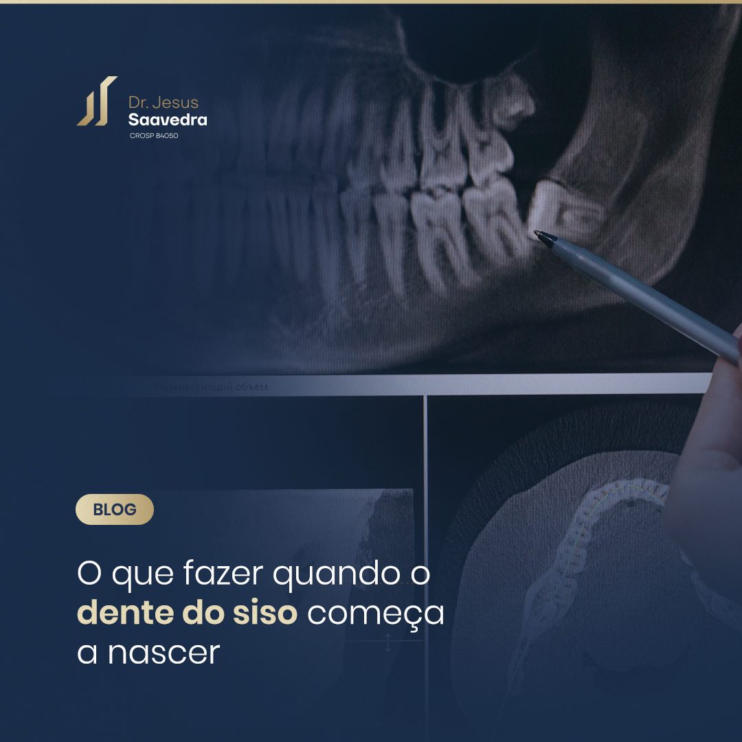 O que fazer quando o dente do siso começa a nascer