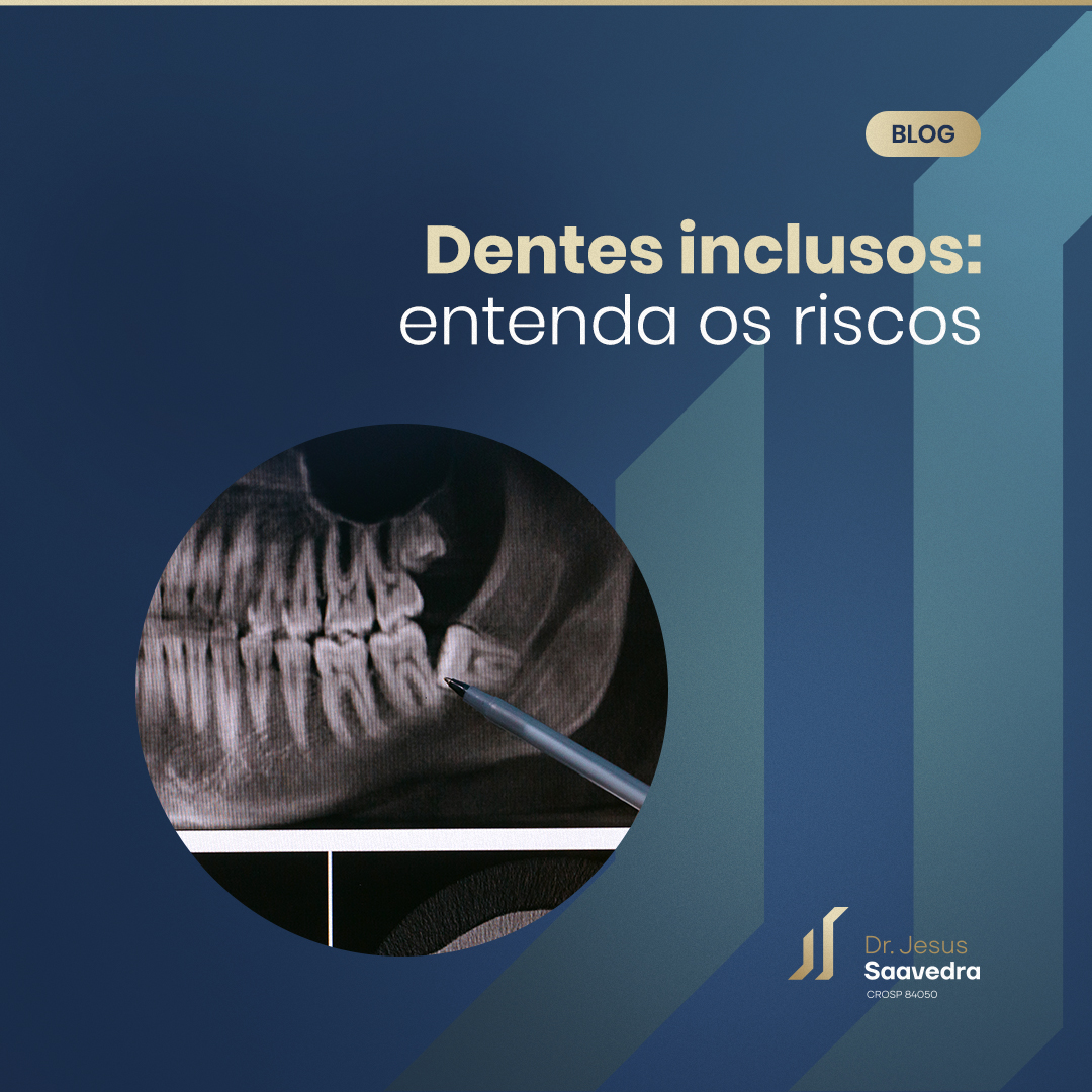 Dentes inclusos: entenda os riscos